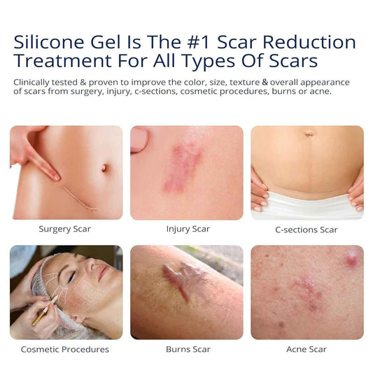 100% Silicone Scar Gel Scar Cream - Advanced Scar Gel for Old and New Scars 🍁 All In One Marketplace Canada